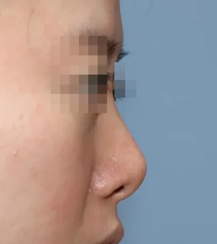 코끝 날개이식 임상 사진