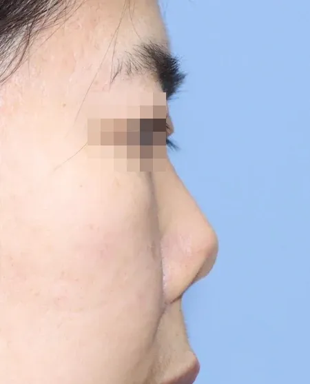 코끝 날개이식 임상 사진