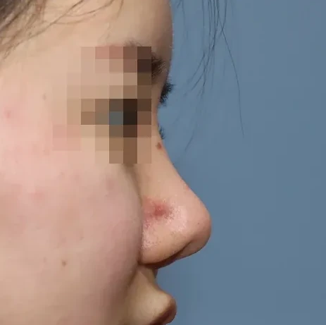 코끝 날개이식 임상 사진