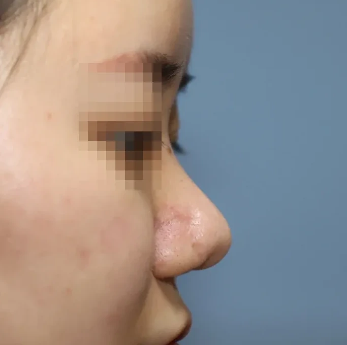코끝 날개이식 임상 사진