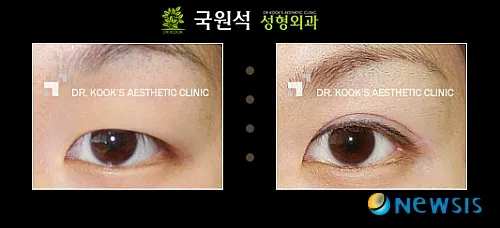 성형외과 전문의에게 듣는 '쌍꺼풀 수술 잘하는 방법' 이미지