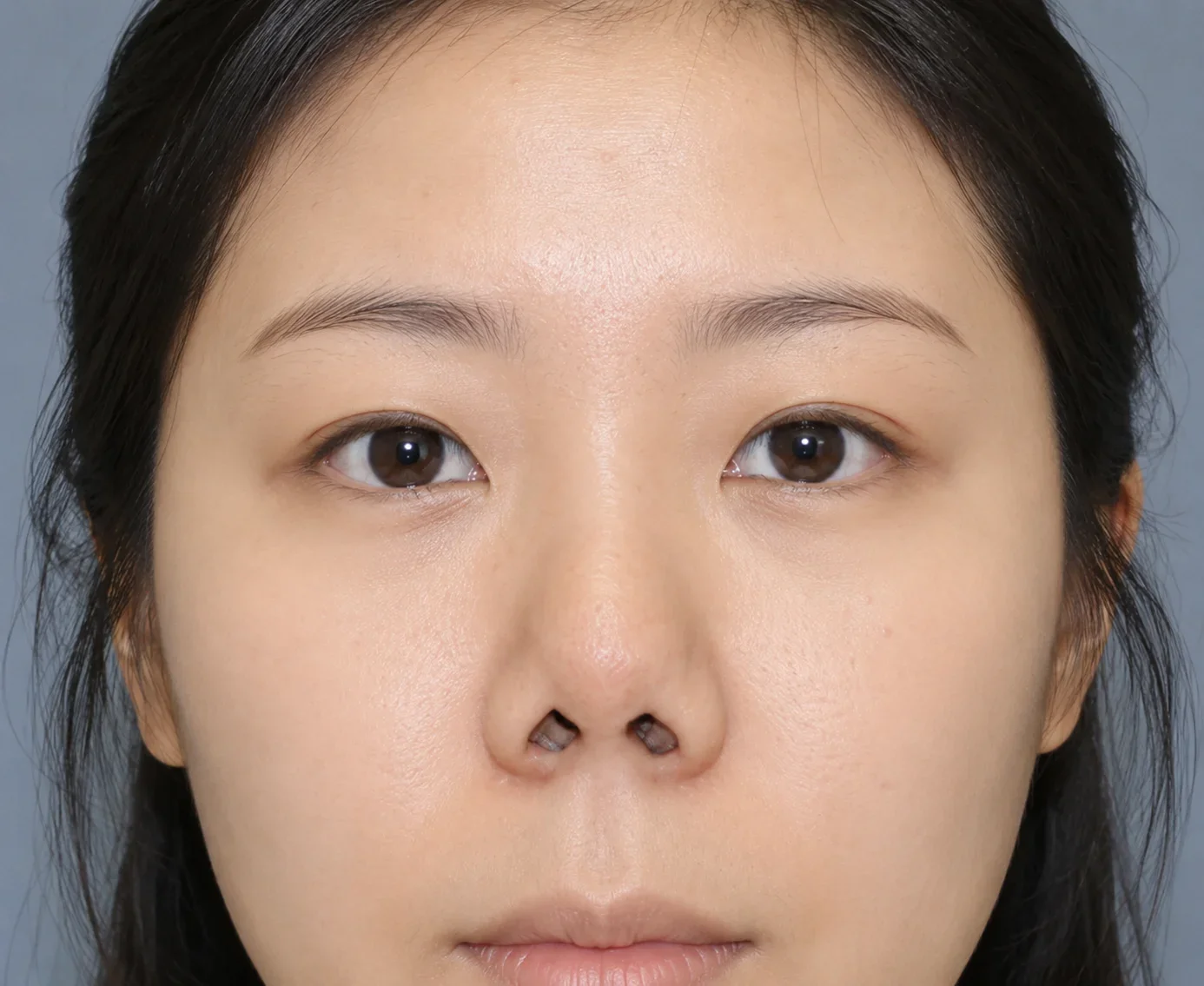 코 길이가 짧고 들려있는 경우 SUTURE 안내 이미지